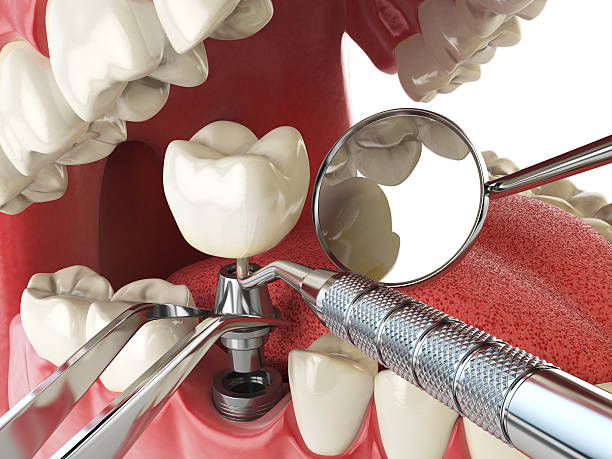 Best Emergency Dental Care for Abscessed Tooth in Dunn Loring, VA